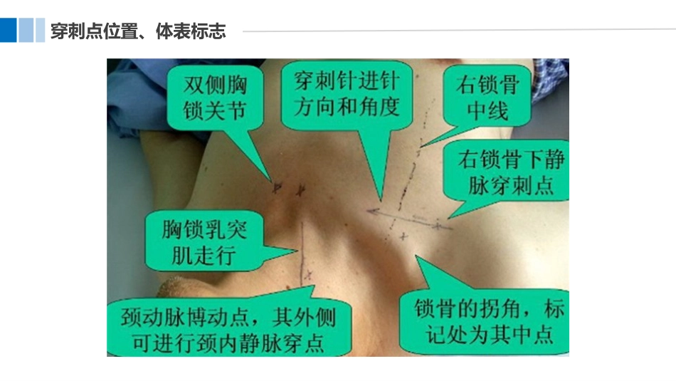 血液透析病人中心静脉导管的护理_第11页