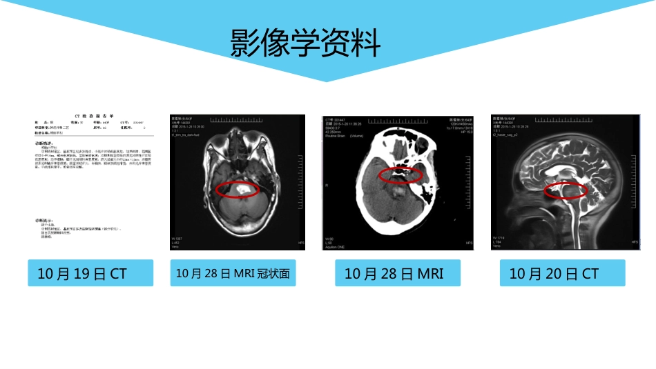 脑出血的护理个案分享_第13页