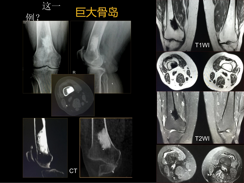 骨肿瘤影像学诊断_第12页
