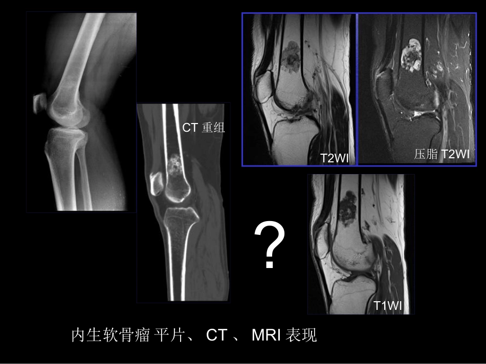 骨肿瘤影像学诊断_第13页