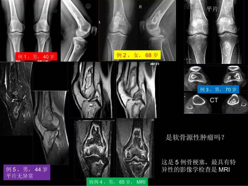 骨肿瘤影像学诊断_第14页