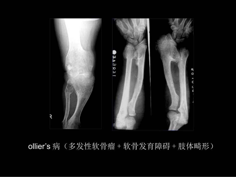 骨肿瘤影像学诊断_第15页