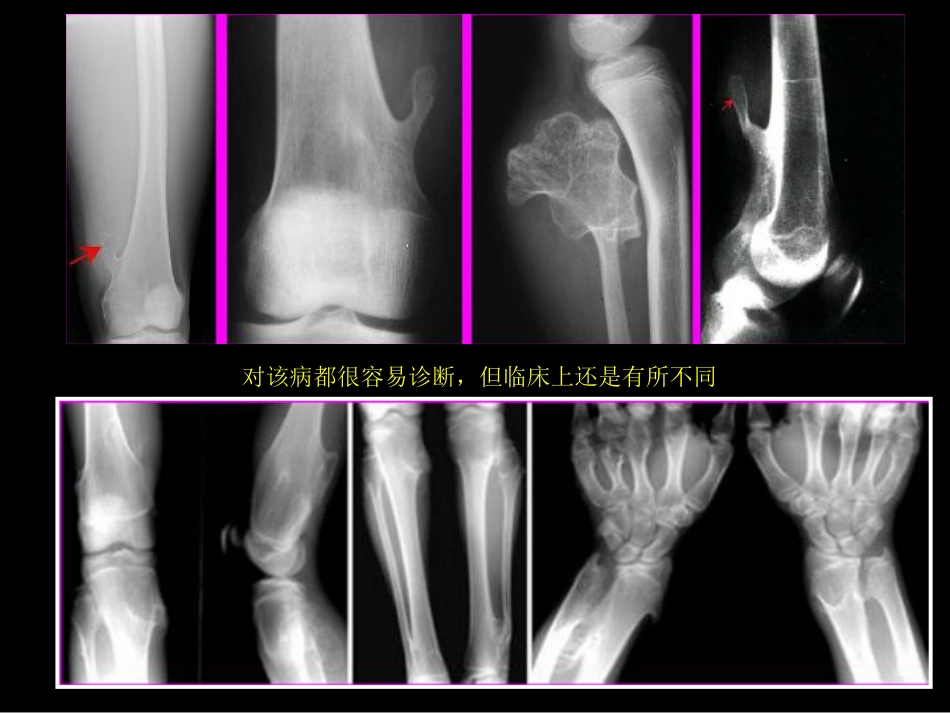 骨肿瘤影像学诊断_第5页