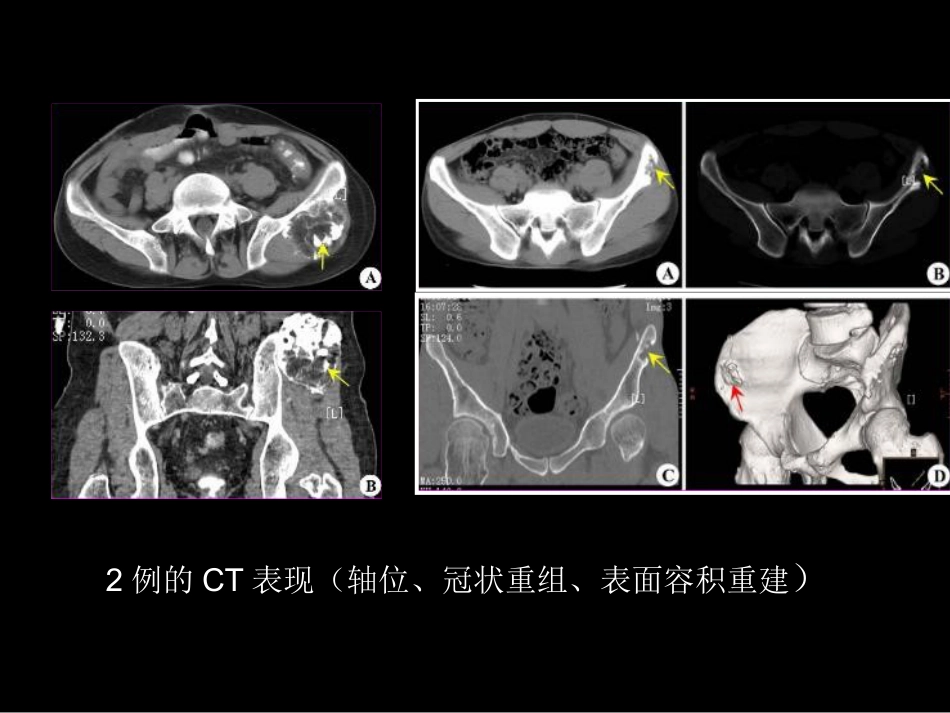 骨肿瘤影像学诊断_第6页