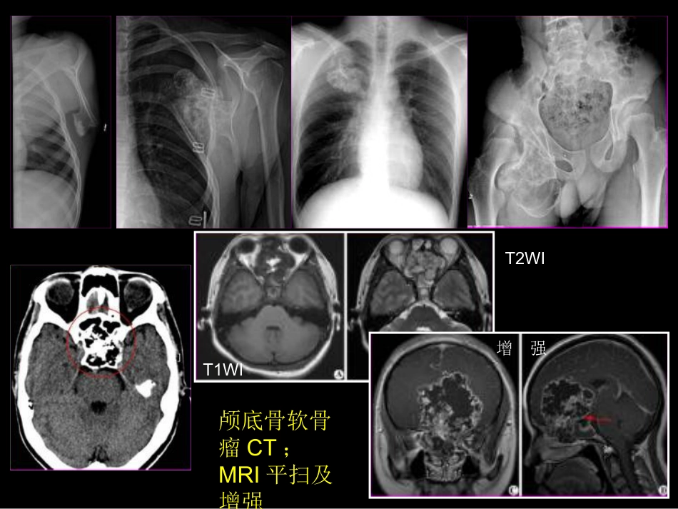 骨肿瘤影像学诊断_第7页