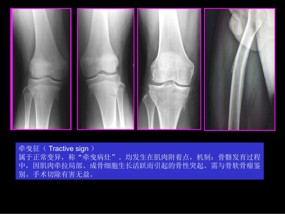 骨肿瘤影像学诊断_第9页