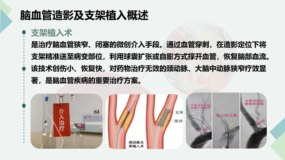 脑血管造影及支架植入术后护理_第6页