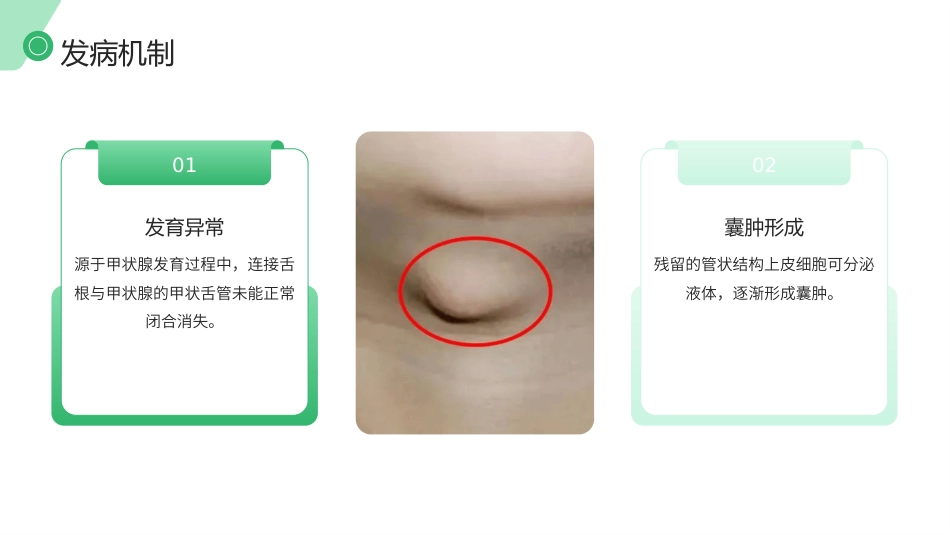 甲状舌管囊肿（TGDC）护理查房带参考文献_第5页