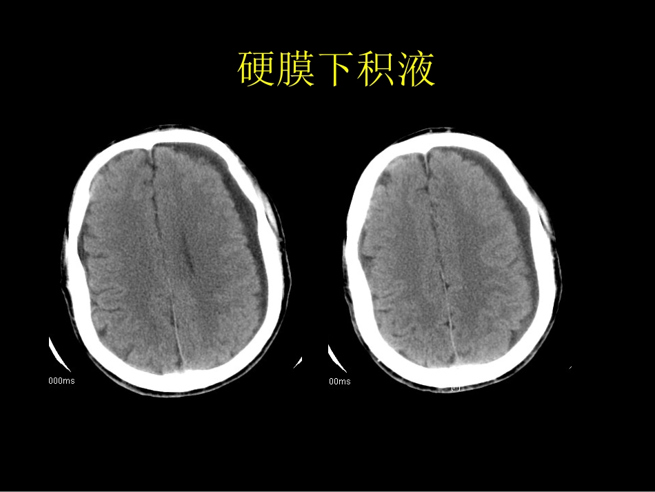 急症影像学诊断_第15页