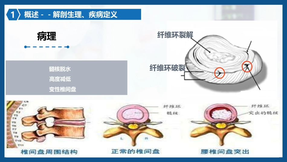 腰椎间盘突出症围手术期护理及康复锻炼1_第9页
