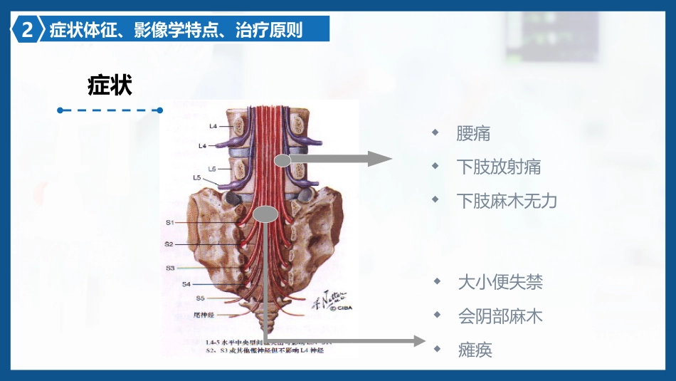 腰椎间盘突出症围手术期护理及康复锻炼1_第12页