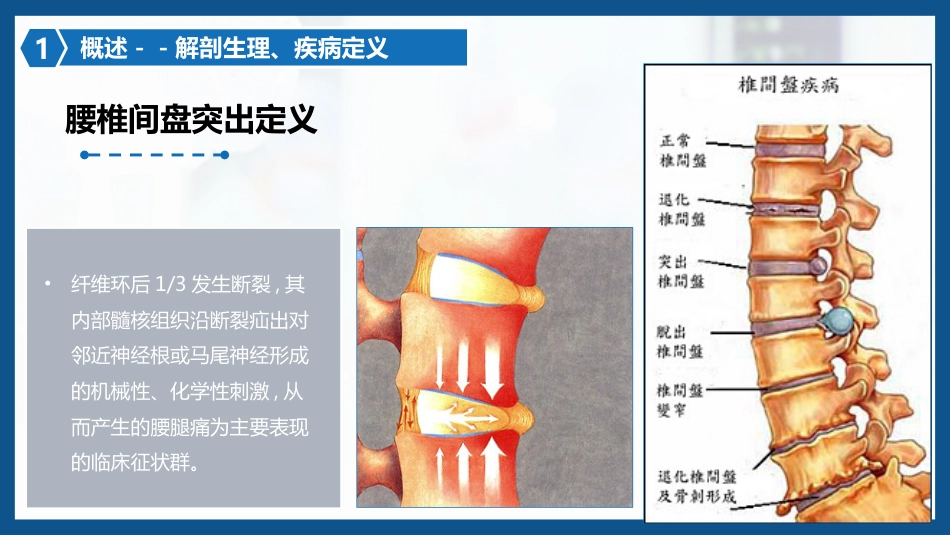腰椎间盘突出症围手术期护理及康复锻炼1_第7页
