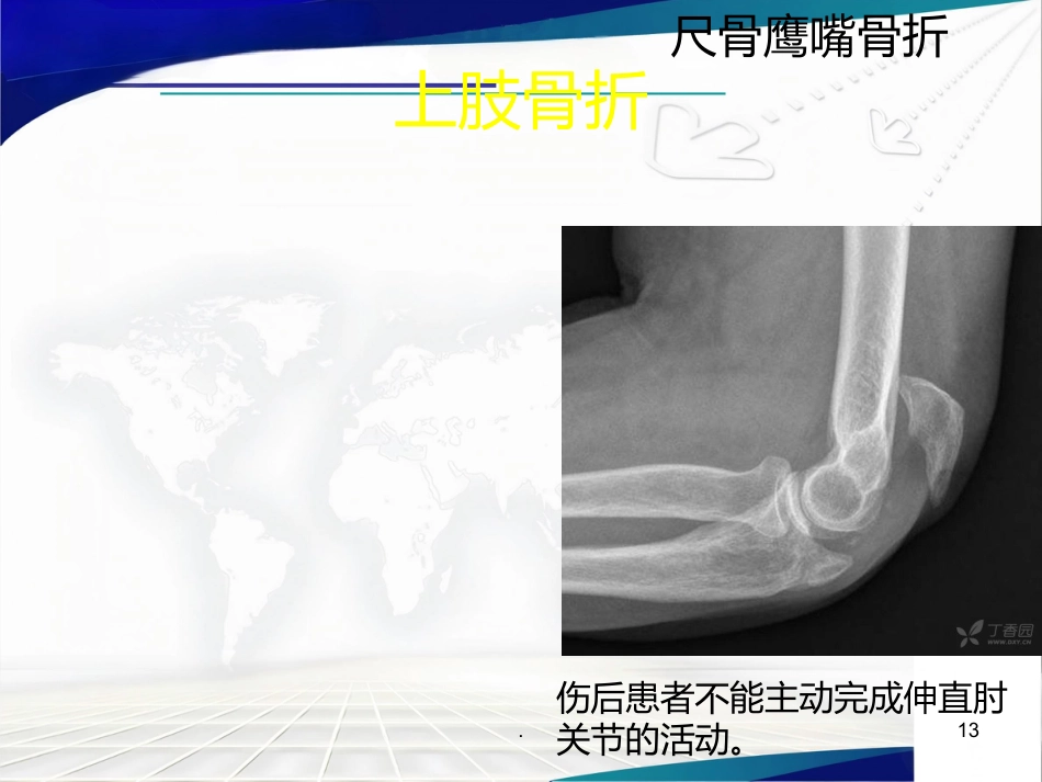 骨科 体位护理_第13页