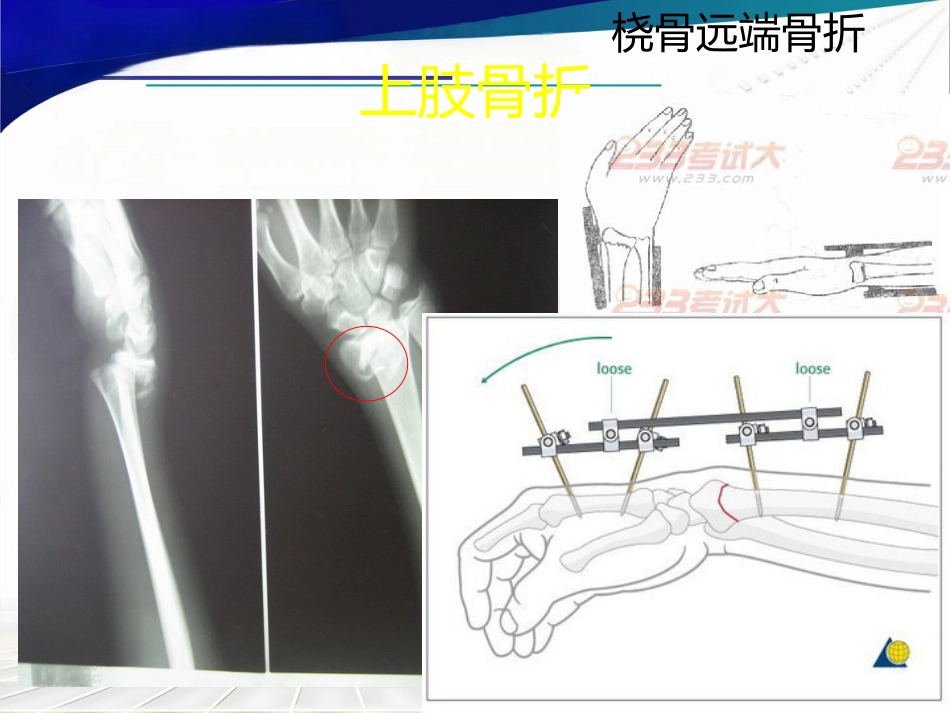 骨科 体位护理_第15页