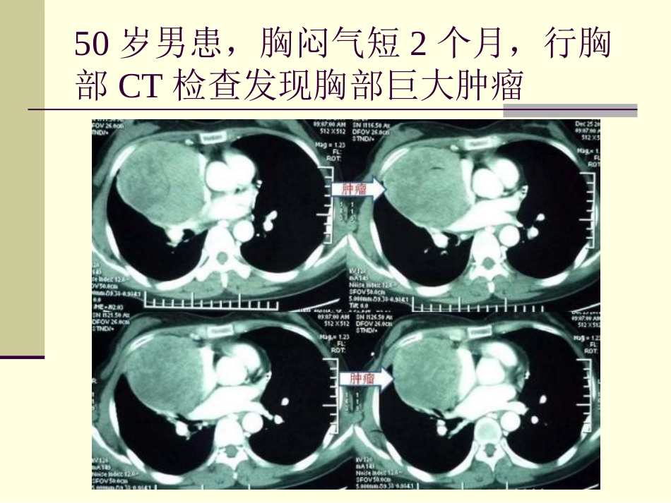 肿瘤科-纵隔肿瘤_第2页