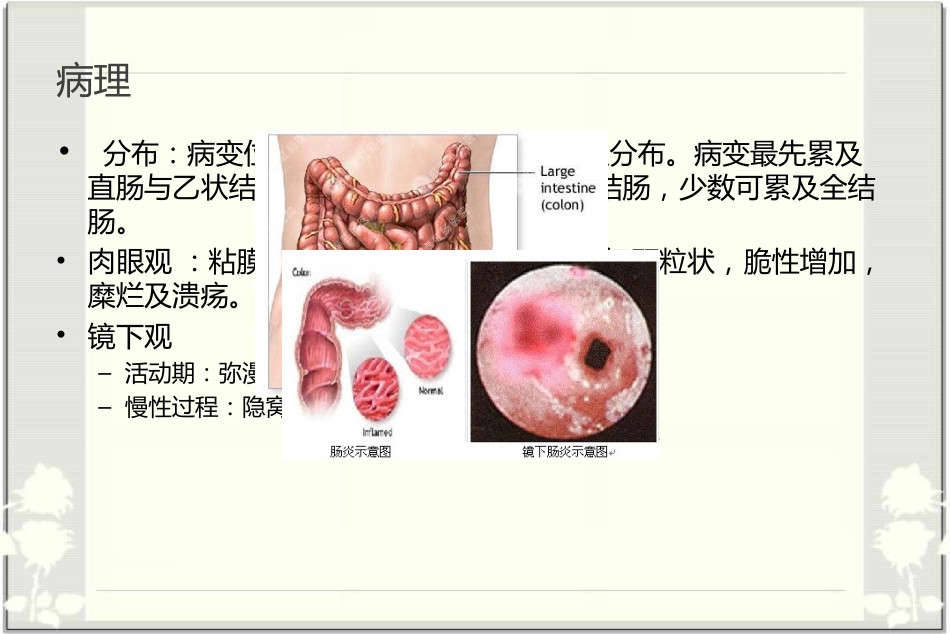 消化内科-溃疡性结肠炎_第3页