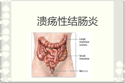 消化内科-溃疡性结肠炎