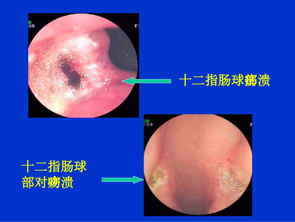 消化内科-上消化道出血课件_第10页