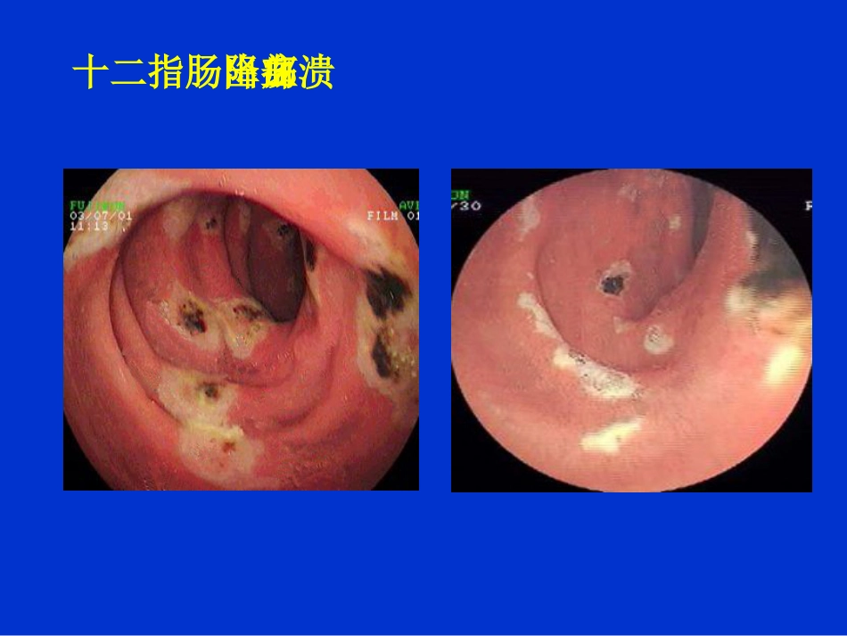消化内科-上消化道出血课件_第11页