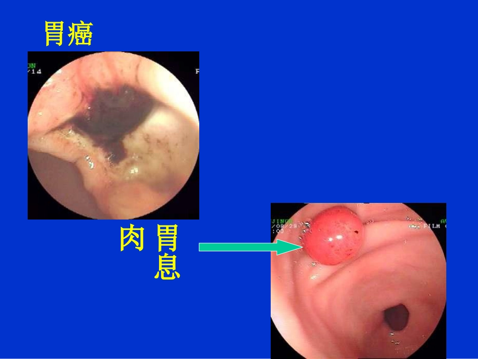 消化内科-上消化道出血课件_第12页