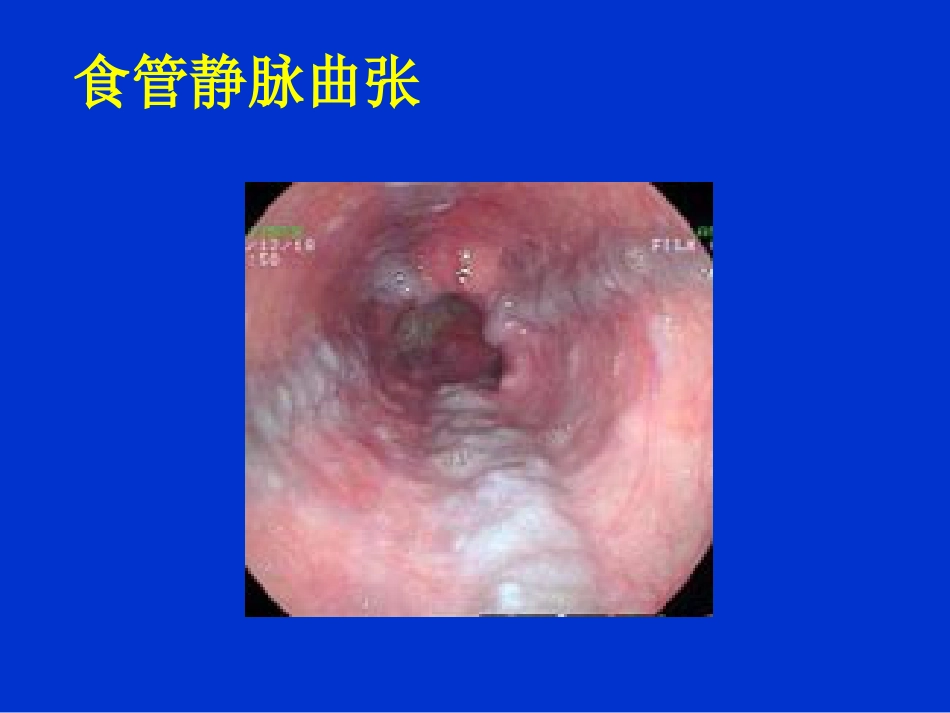 消化内科-上消化道出血课件_第14页