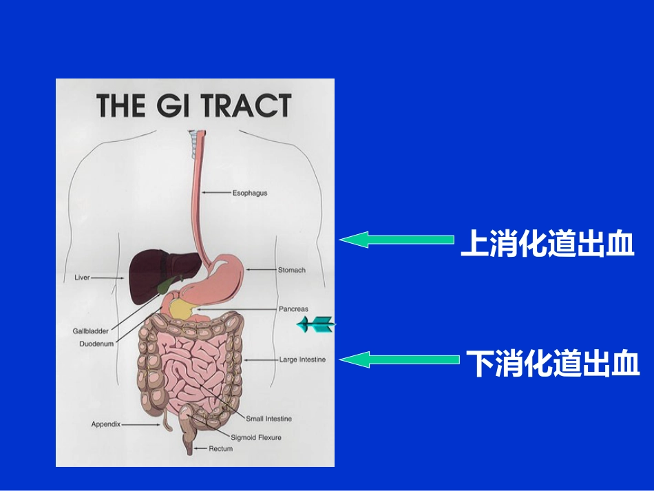 消化内科-上消化道出血课件_第2页