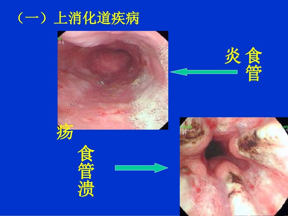 消化内科-上消化道出血课件_第8页