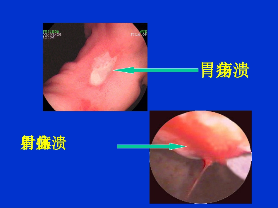 消化内科-上消化道出血课件_第9页