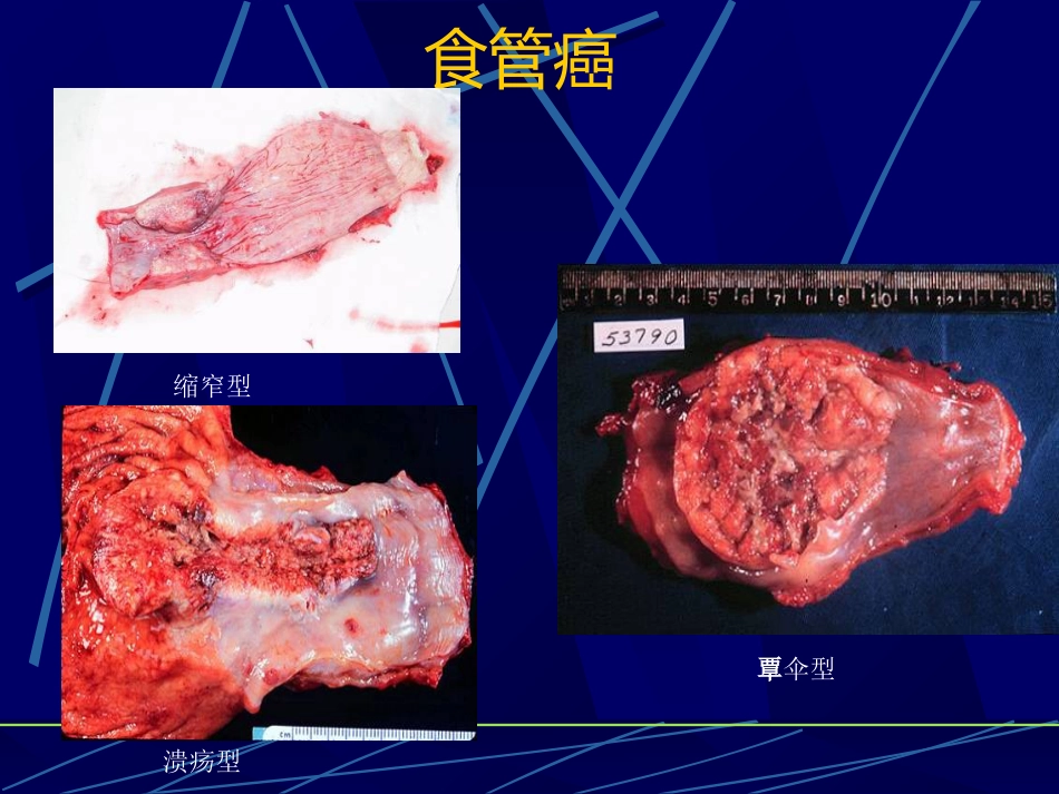 消化内科食管疾病(临床系教案)_第12页