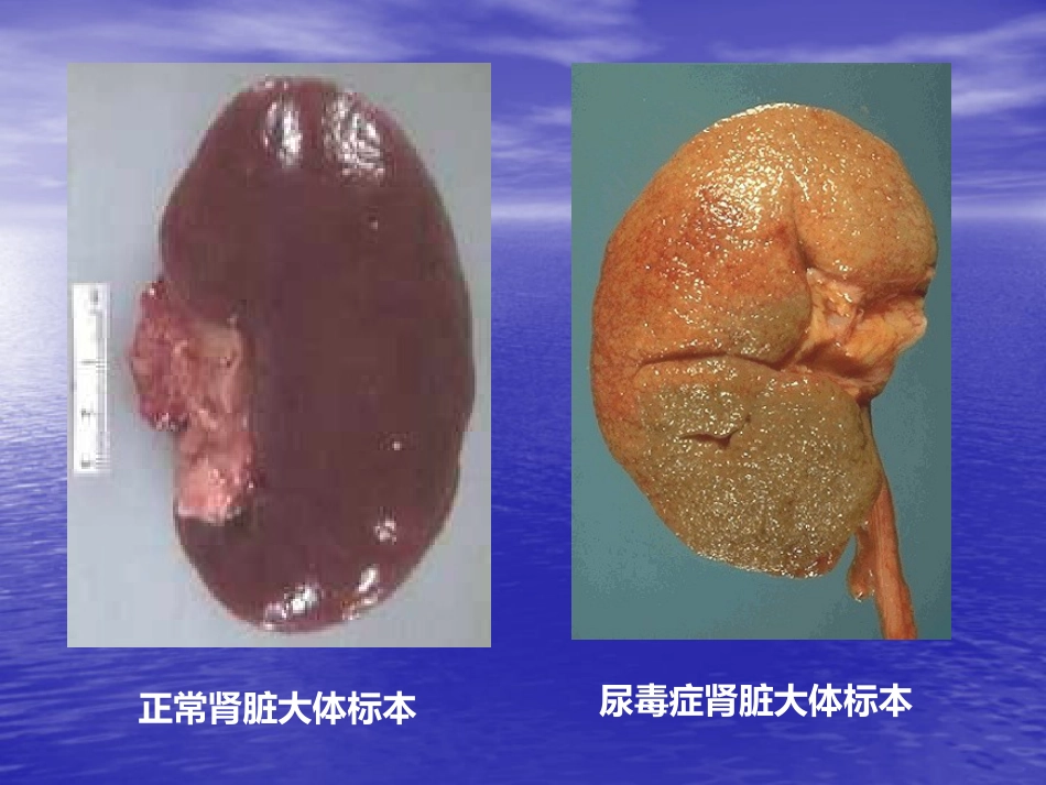肾内科-慢性肾衰竭_第7页