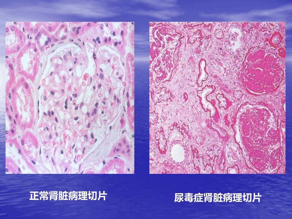 肾内科-慢性肾衰竭_第8页