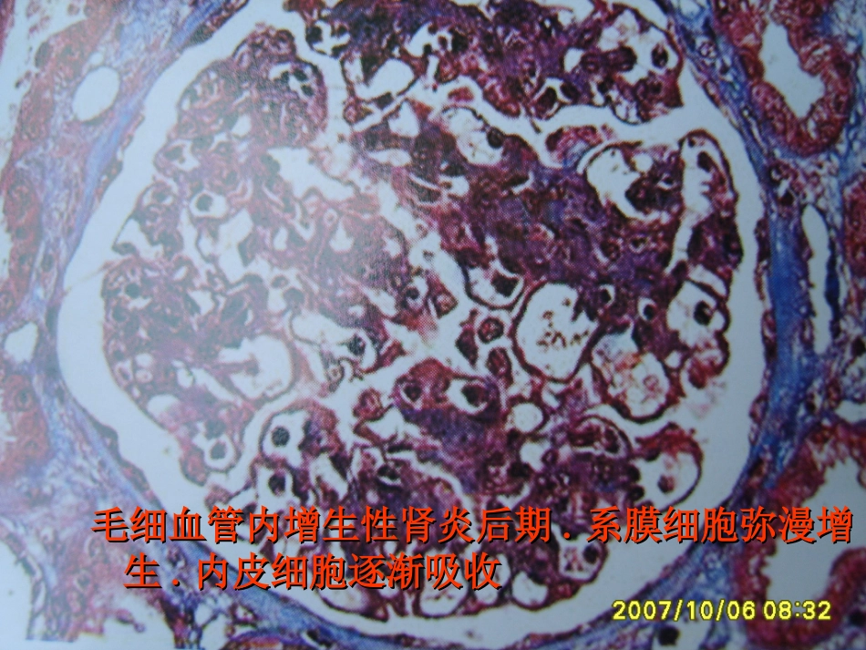 肾内科-肾小球肾炎_第10页