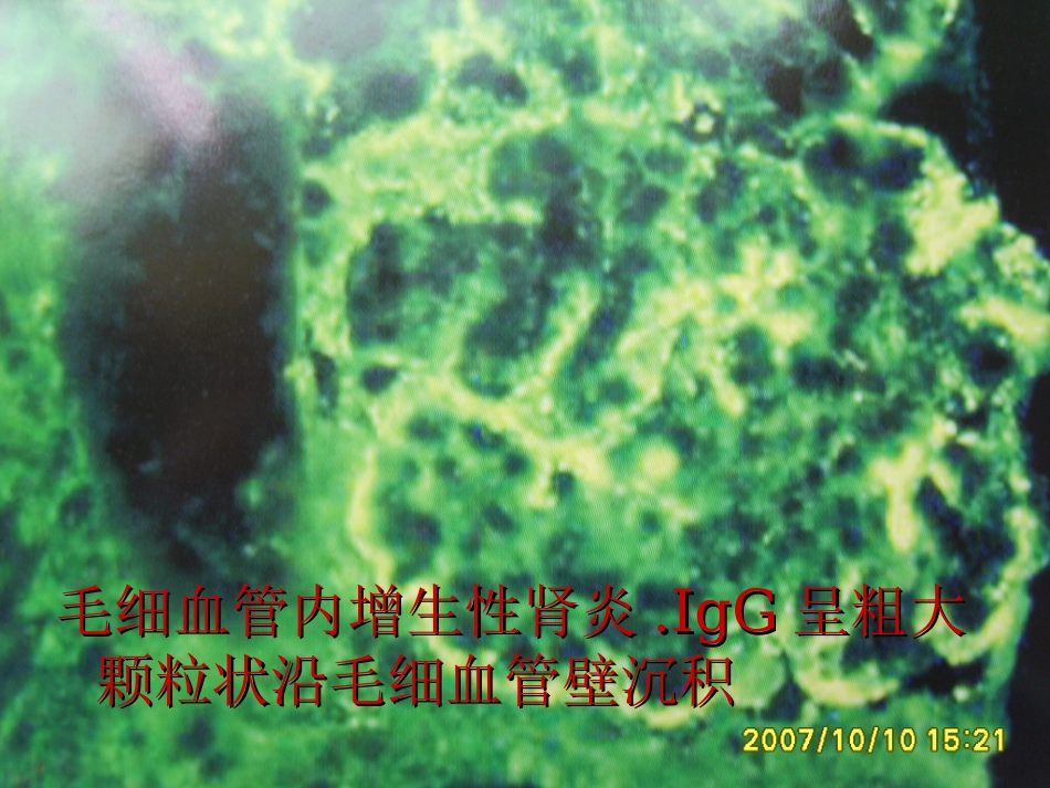 肾内科-肾小球肾炎_第11页