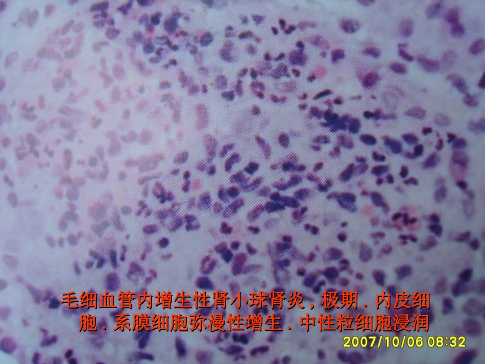 肾内科-肾小球肾炎_第9页