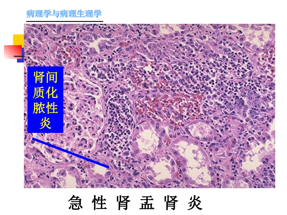 肾内科-肾盂肾炎1_第10页