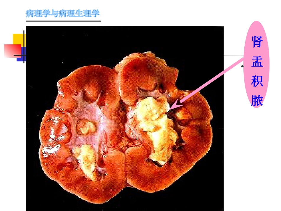 肾内科-肾盂肾炎1_第14页