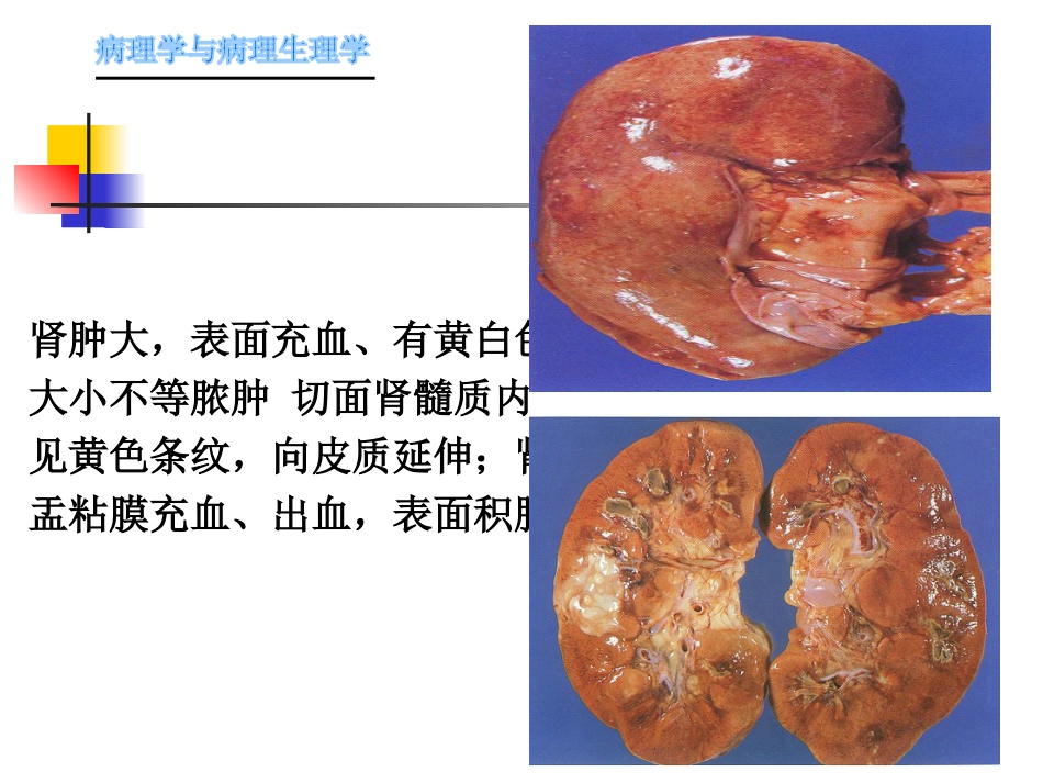 肾内科-肾盂肾炎1_第8页