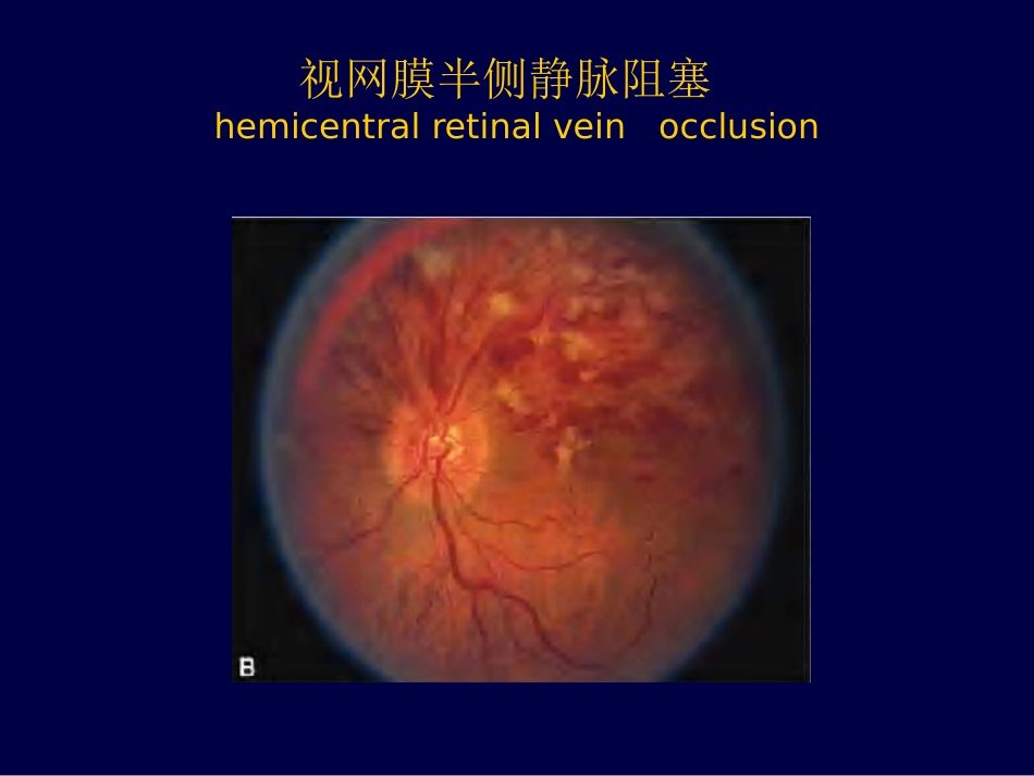 眼底病、眼与全身病备份_第14页