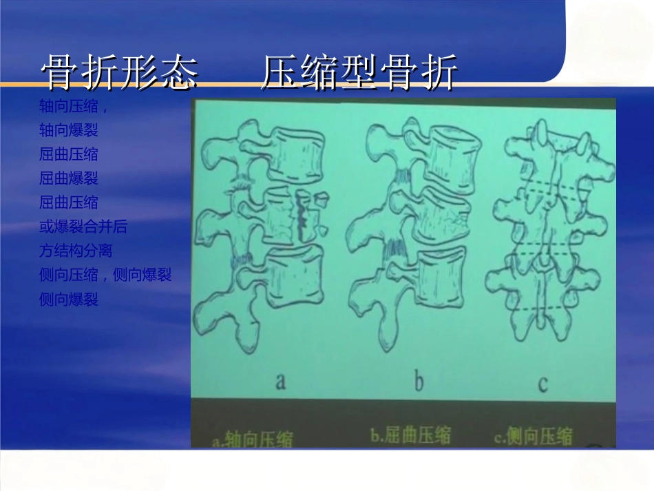 胸腰椎 骨折选择治疗_第13页