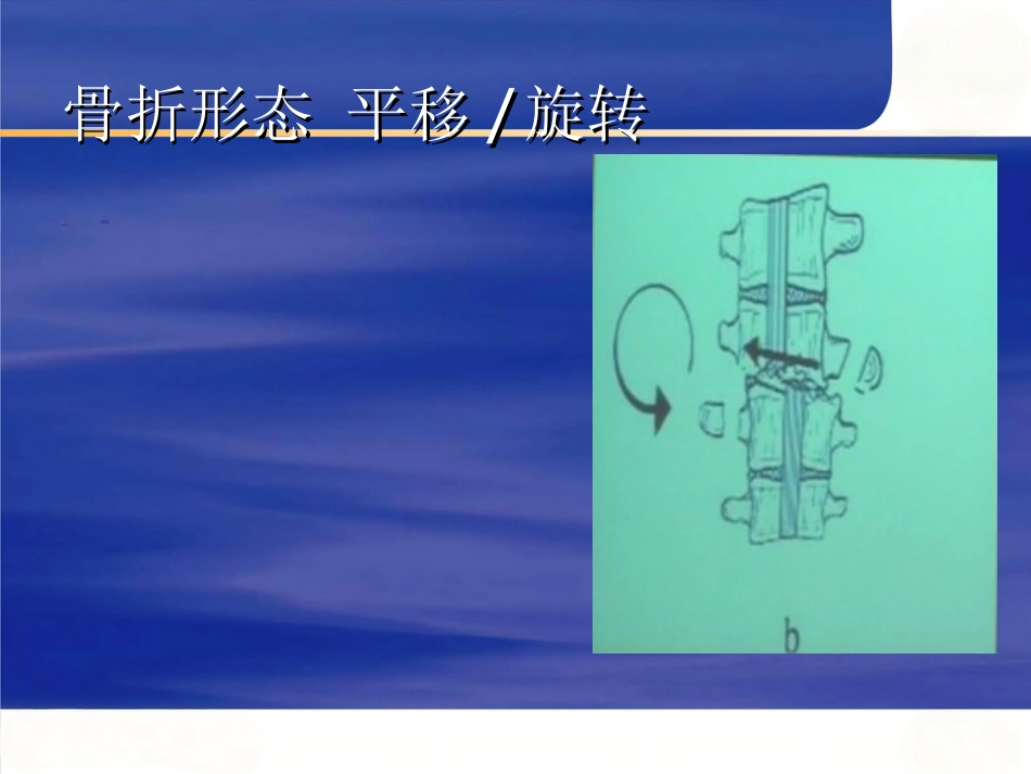 胸腰椎 骨折选择治疗_第14页