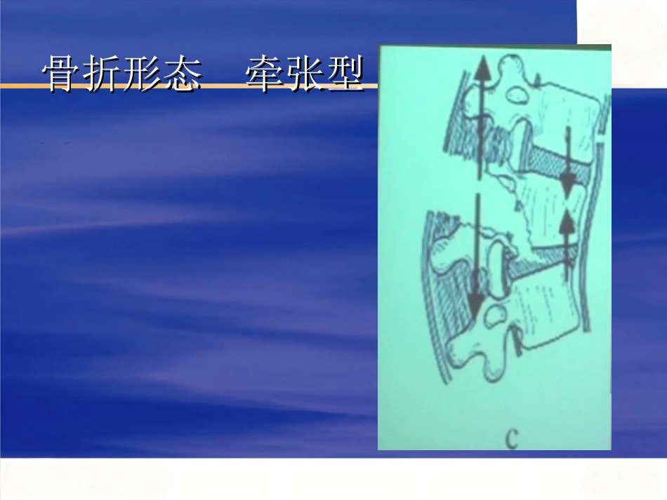 胸腰椎 骨折选择治疗_第15页