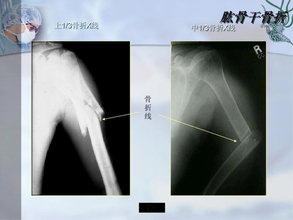 肱骨干骨折PPT_第13页