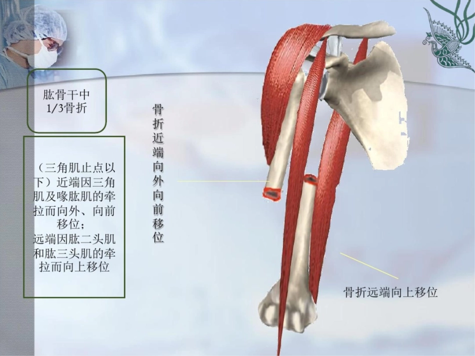 肱骨干骨折PPT_第6页