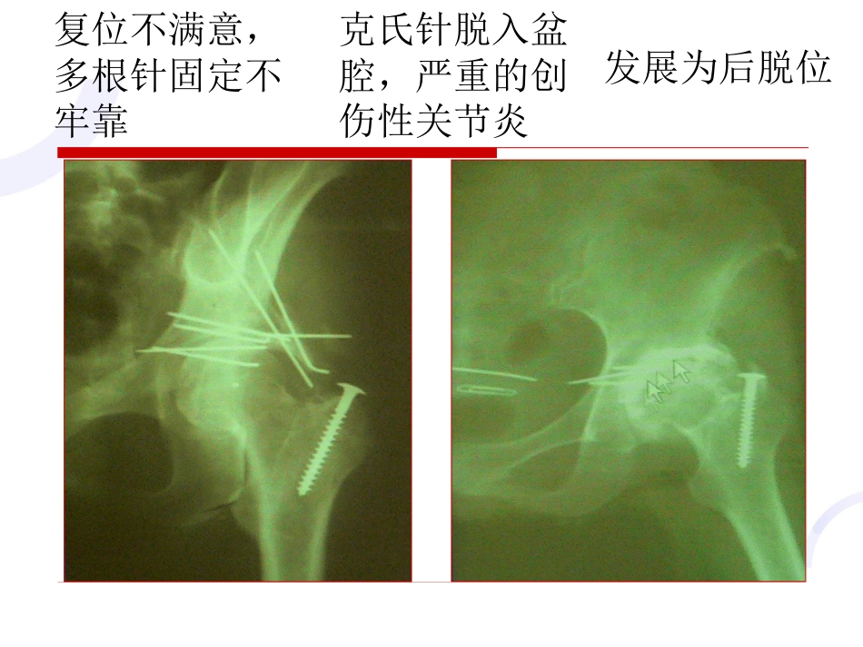 髋臼 骨折_第10页