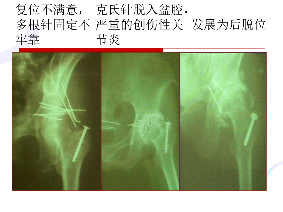 髋臼 骨折_第11页