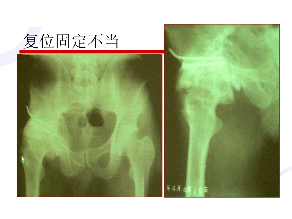 髋臼 骨折_第12页