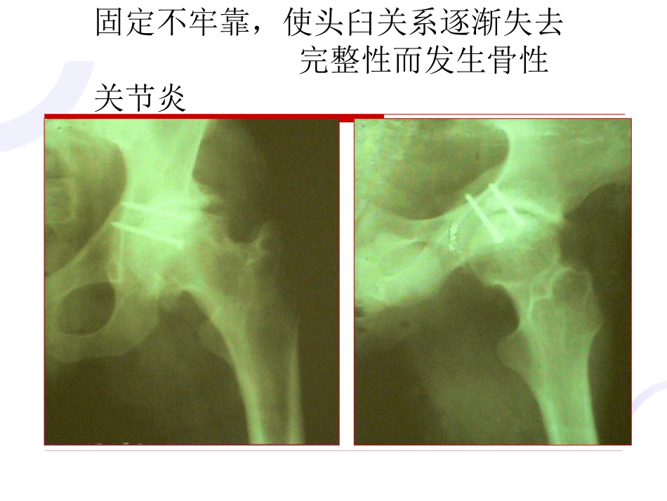 髋臼 骨折_第13页