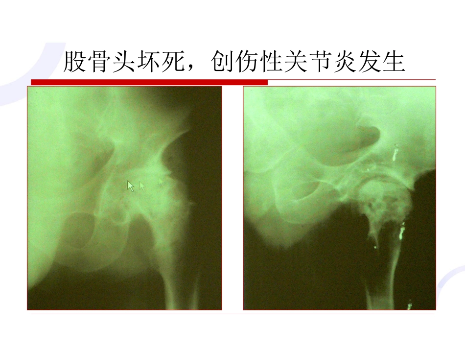 髋臼 骨折_第14页