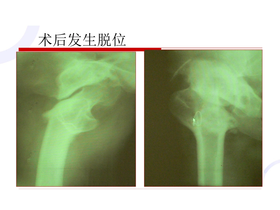 髋臼 骨折_第15页