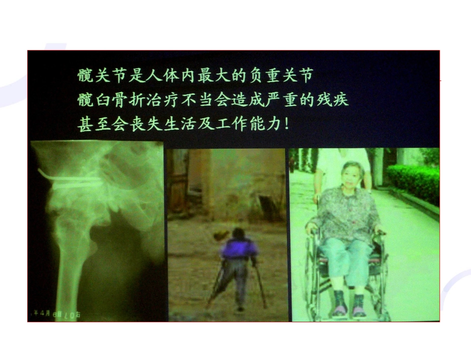 髋臼 骨折_第2页